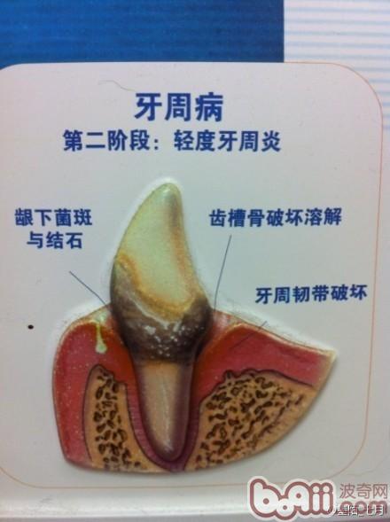 3.牙菌斑
